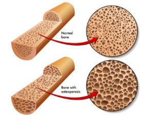osteoporosis