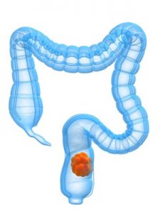 colon cancer