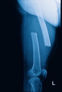 Bone Fracture